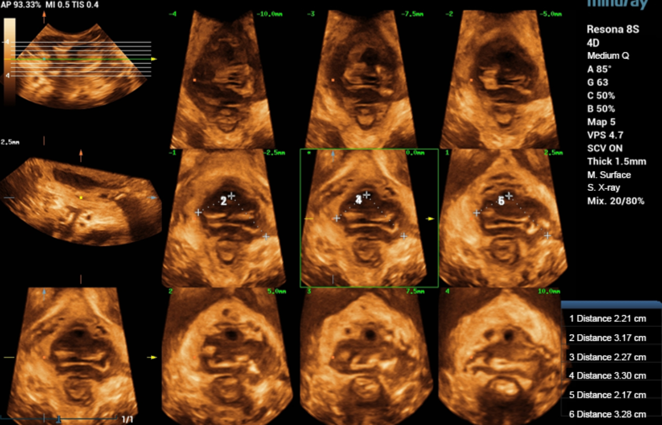 levator-trauma-fig6-pc