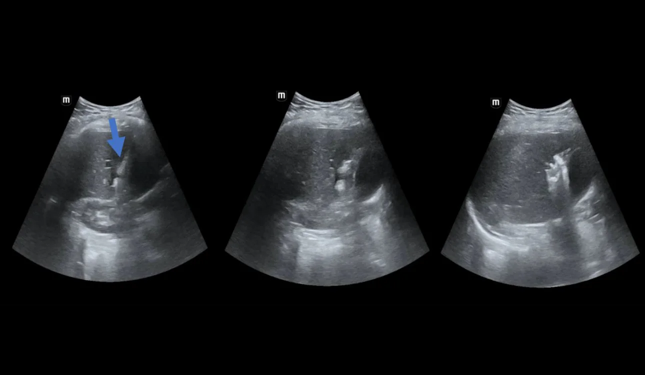 thermal-ablation-fig1-pc