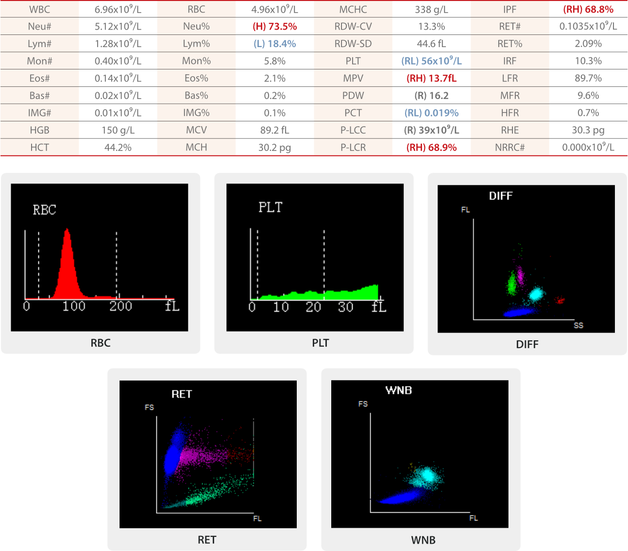 thrombocytopenia-smear-fig2-pc