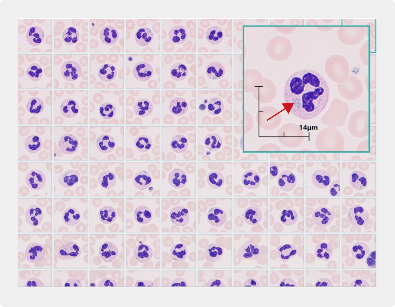 thrombocytopenia-smear-fig5-pc