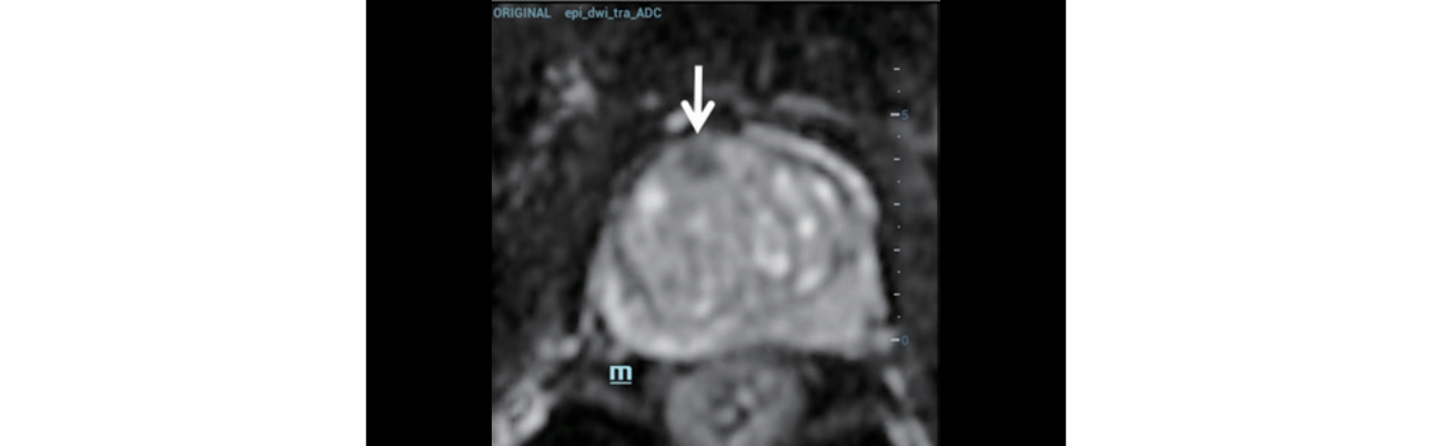 trus-mri-fusion-fig2-pc