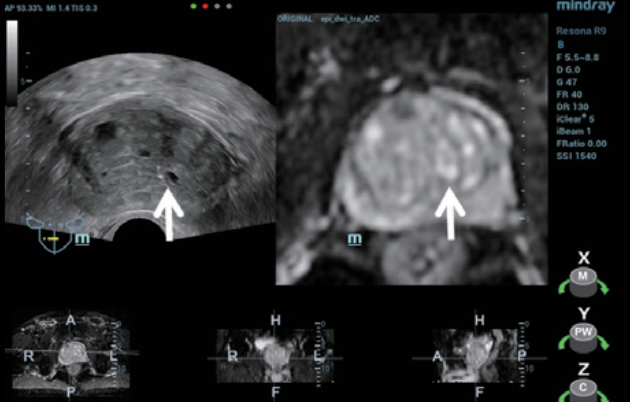 trus-mri-fusion-fig3-pc