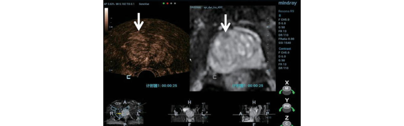 trus-mri-fusion-fig5-pc