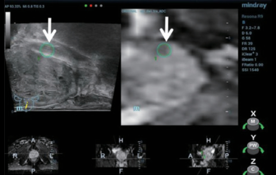 trus-mri-fusion-kv-pc