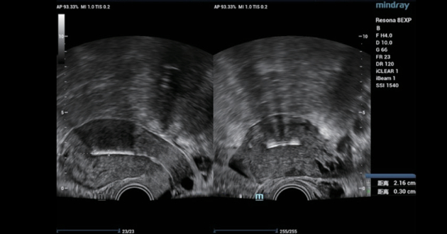 intrauterine-device-fig1-pc