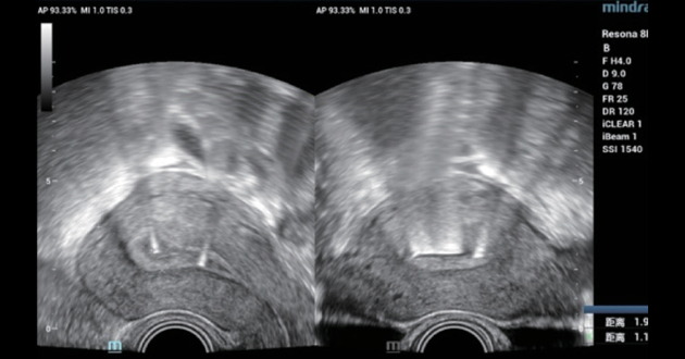 intrauterine-device-fig3-pc