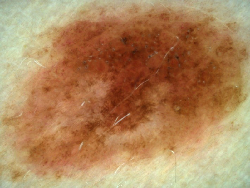 Dermatoscopic examination of the nevus