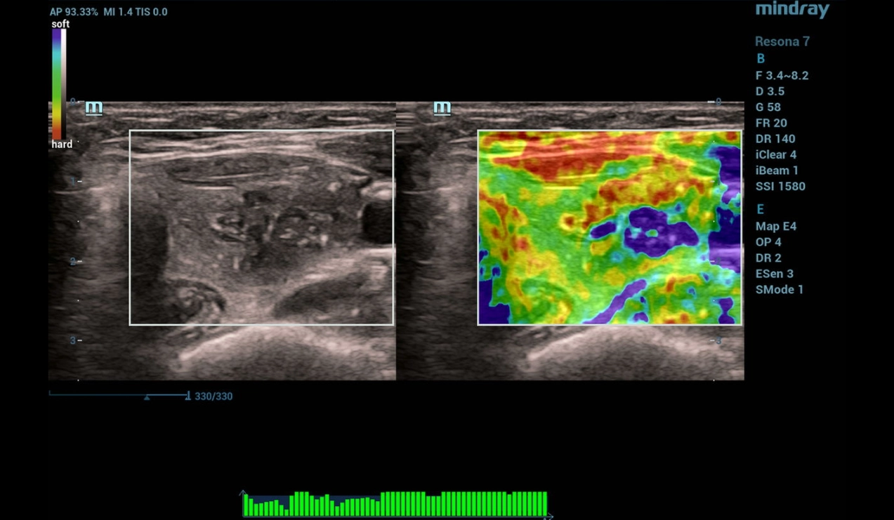 throid-sclerotherapy-fig10-pc