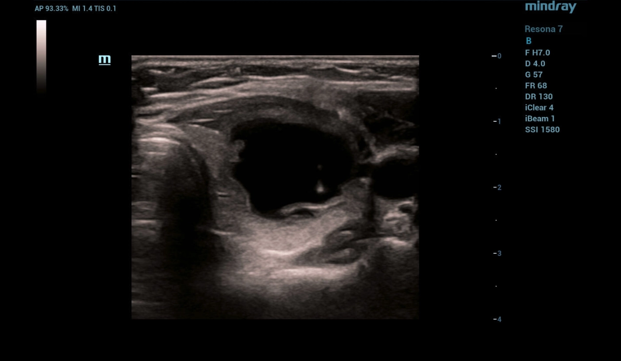 throid-sclerotherapy-fig4-pc