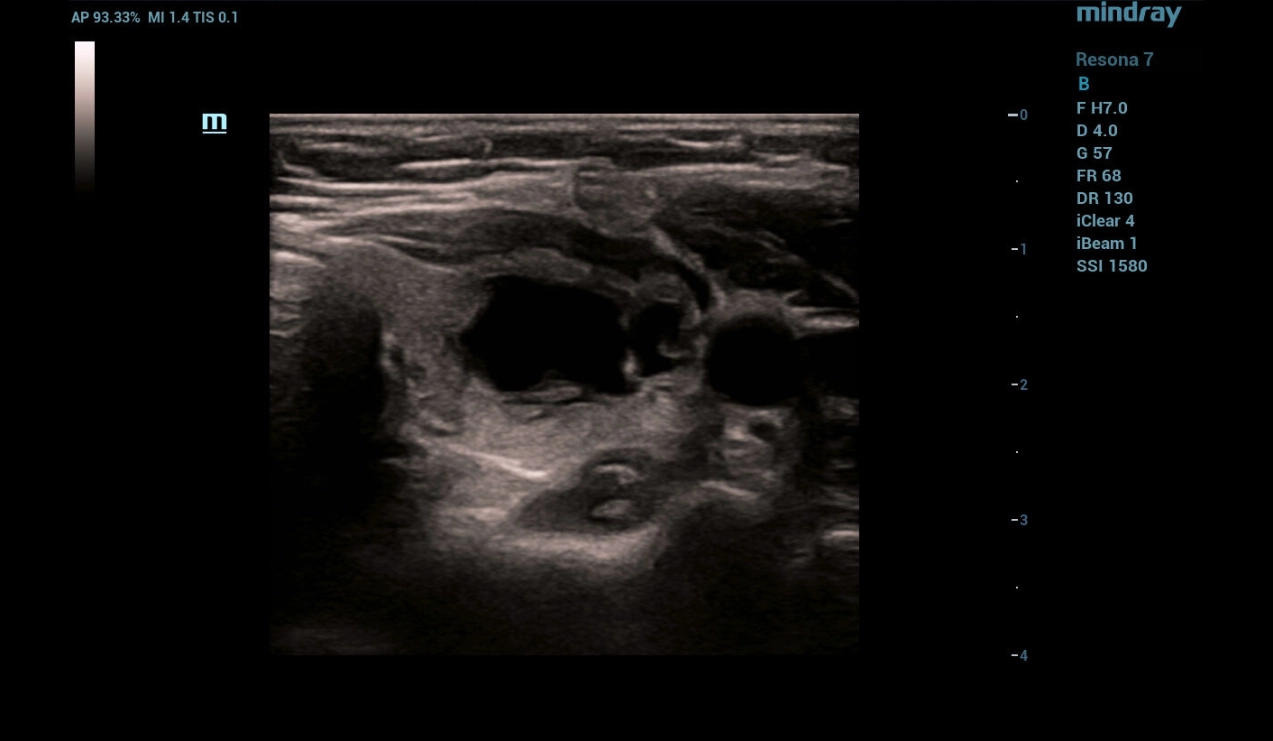 throid-sclerotherapy-fig5-pc