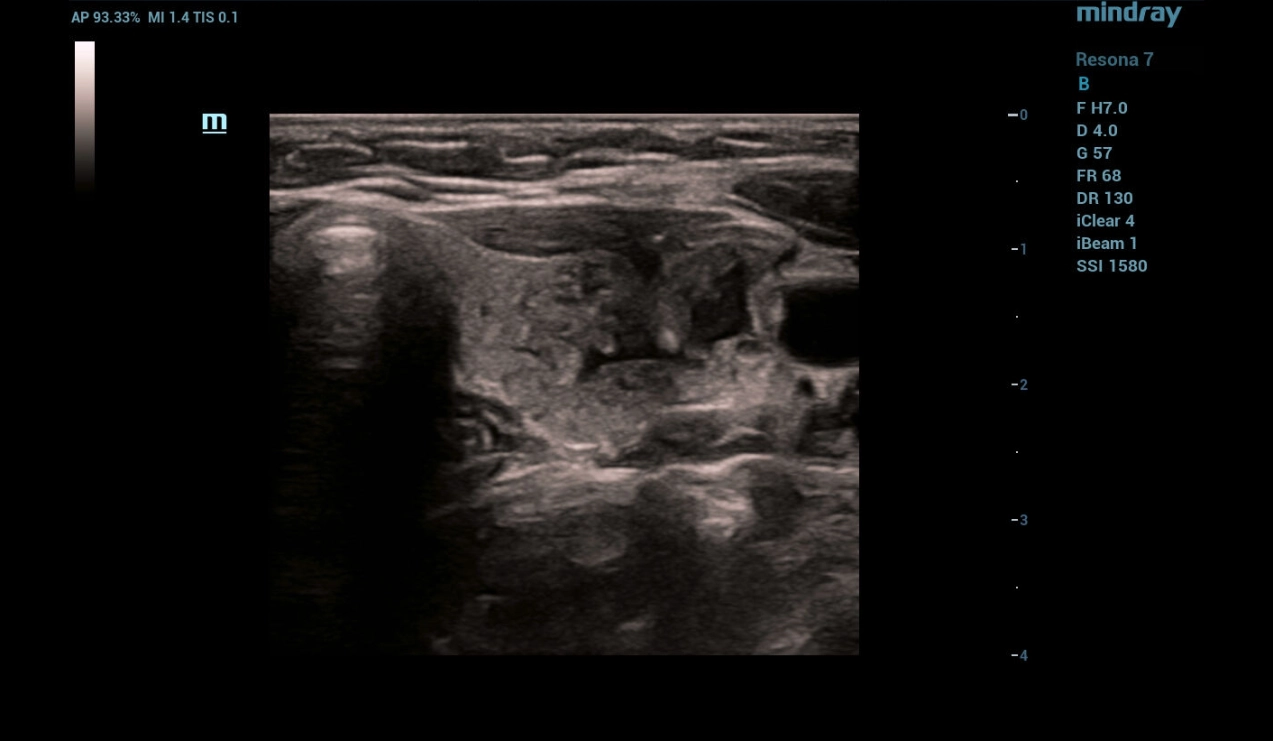 throid-sclerotherapy-fig6-pc