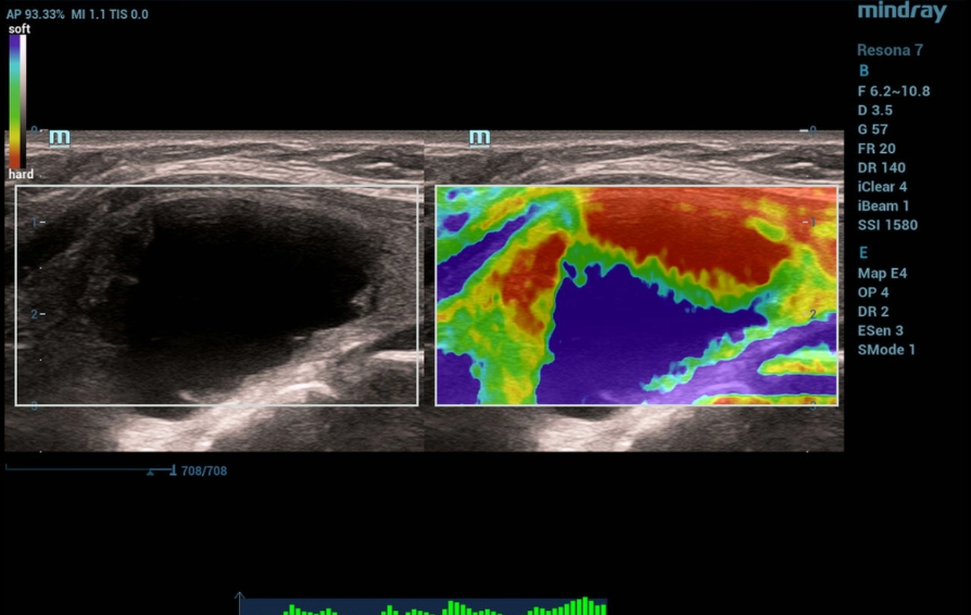 throid-sclerotherapy-kv-pc