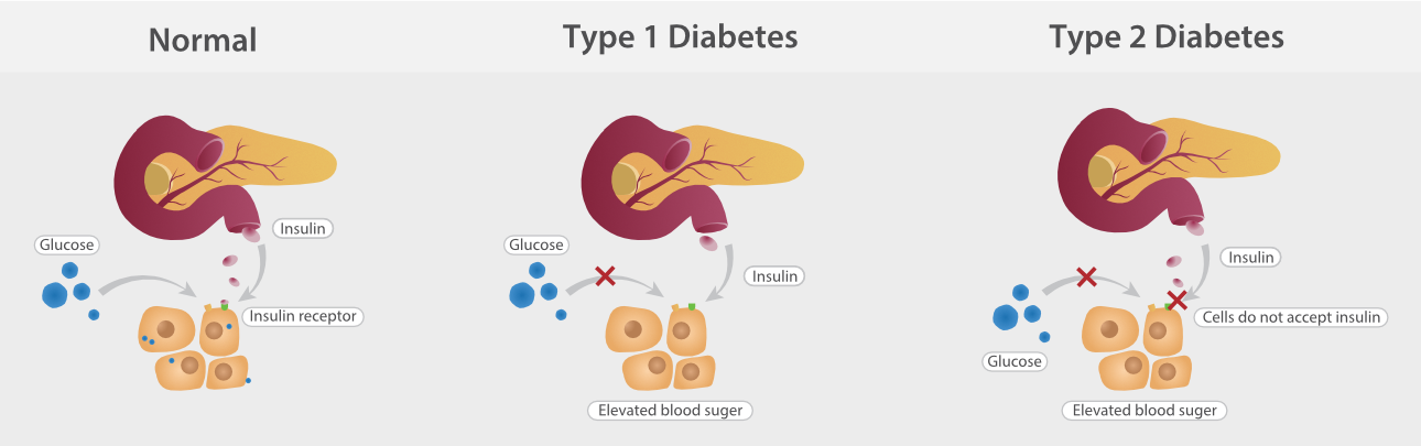 IVD Education: What is Diabetes? - In people with diabetes