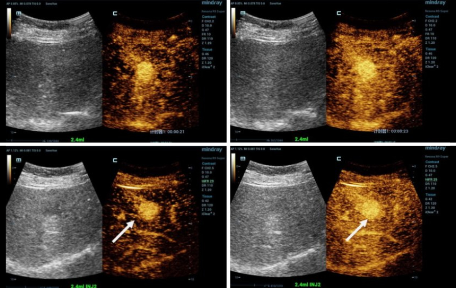 diagnoses-hifr-ceus-kv-pc