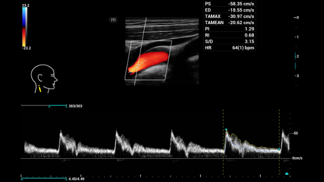 Consona Series Cardiovascular Solution - Smart Calc feature clinical image