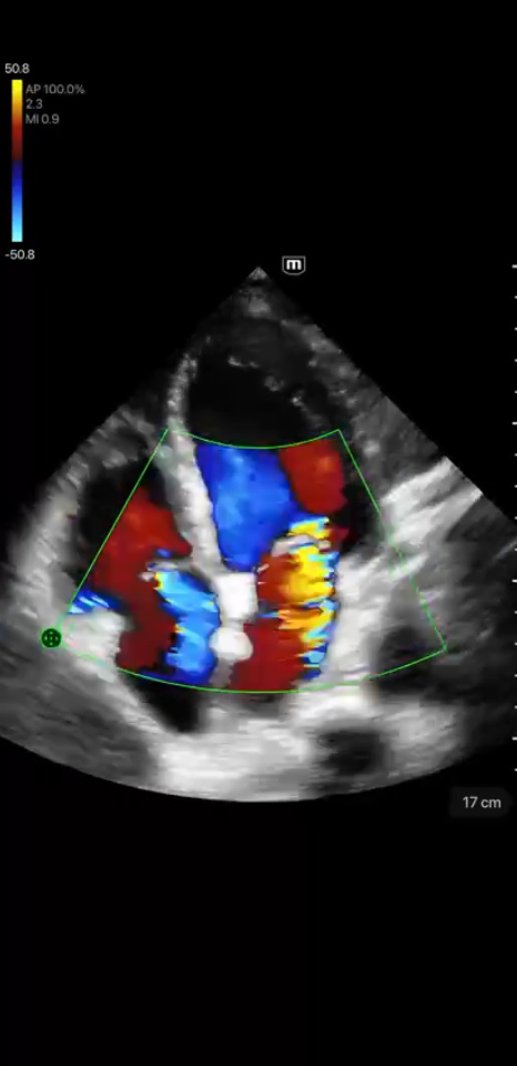 Mitral and Tricuspid Regurgitation