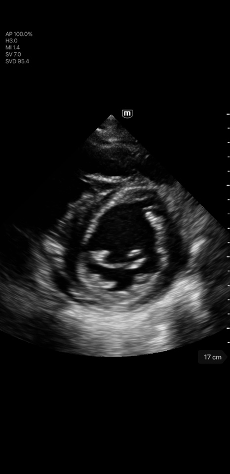 Pericardial Effusion