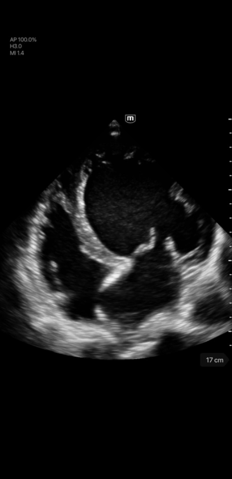 Dilated Cardiomyopathy