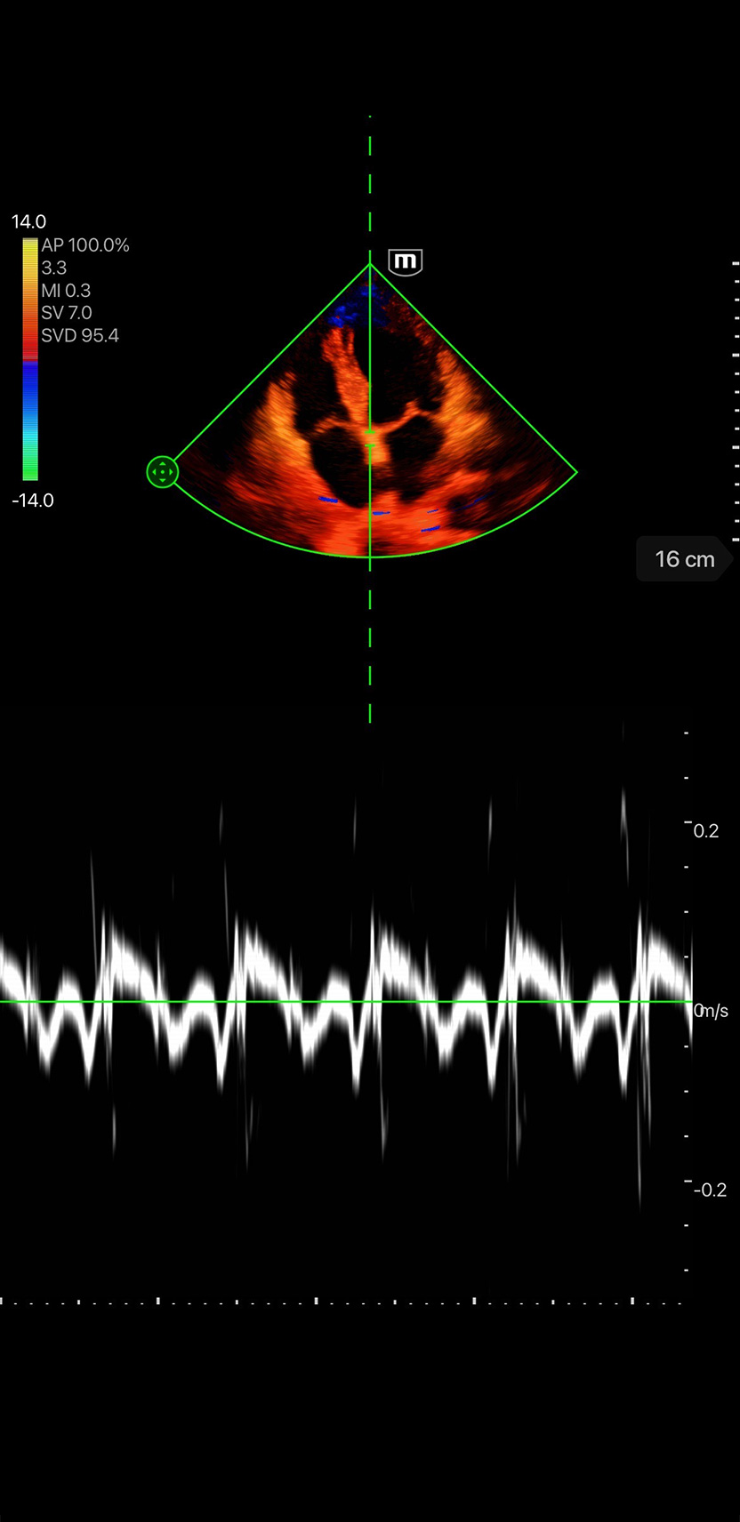 Tissue Velocity Doppler