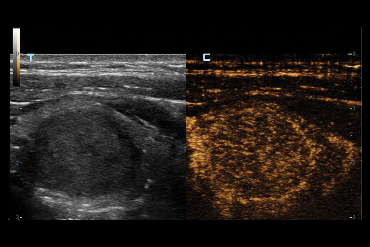 High-Frame-Rate-CEUS-of-Thyroid-Lesion-2-1