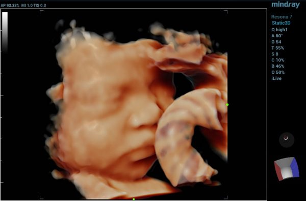 4d-fetal-face-new-600x393