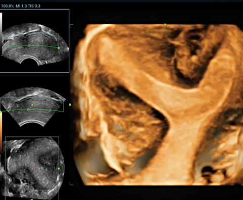 3D Uterus Septus