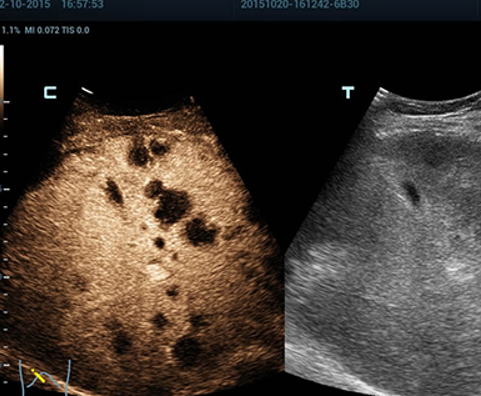 CEUS of Liver Lymphoma 