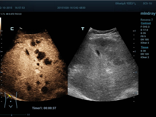 CEUS of Liver Lymphoma