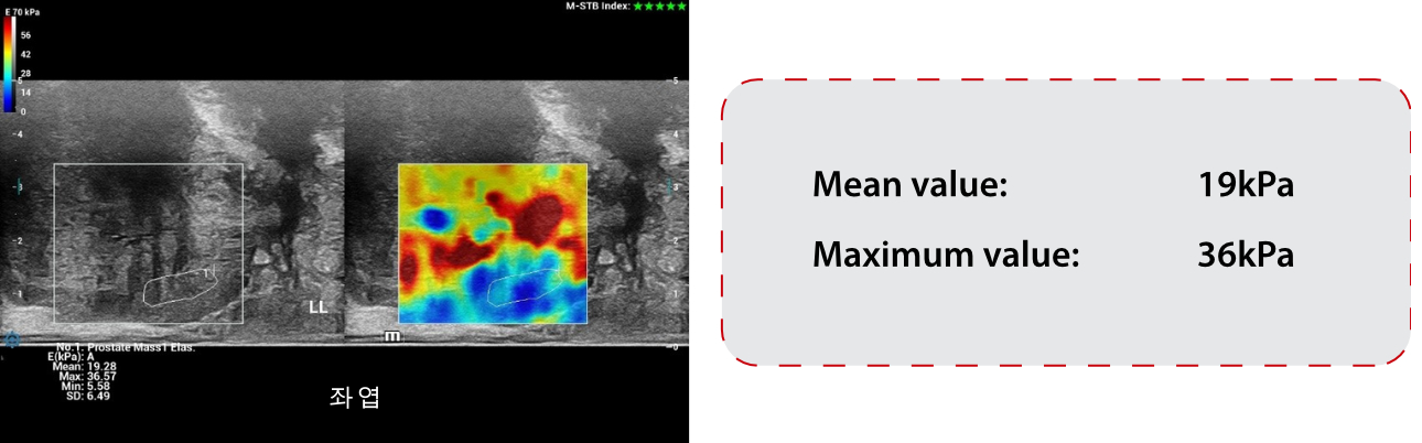 Prostate shearwave left lobe