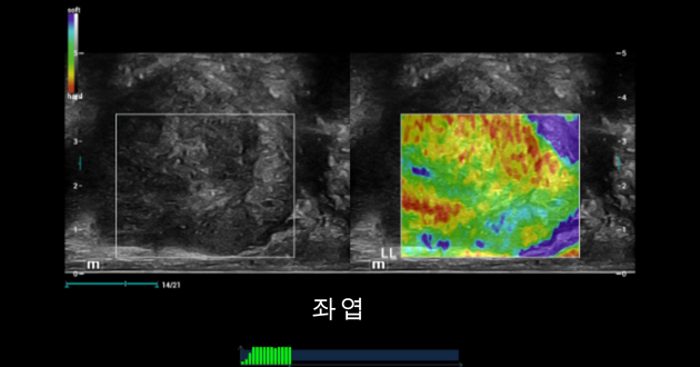 Prostate shearwave left lobe