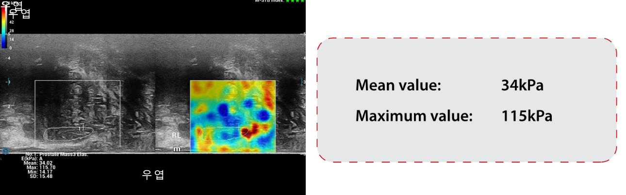 Prostate shearwave right lobe