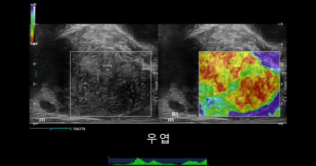 Prostate shearwave right lobe