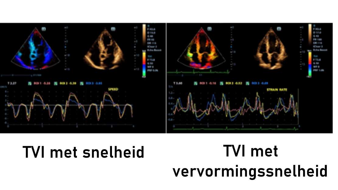 TVI