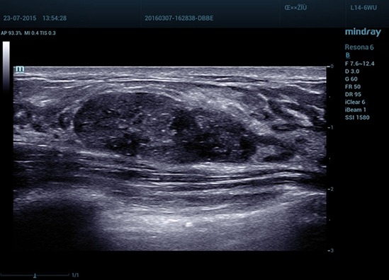 03 Fibroadenoma of Breast