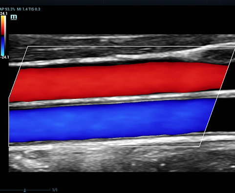 CCA and Jugular Vein