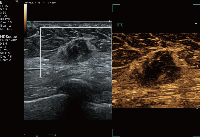 Resona A20 scan for Breast Lesion