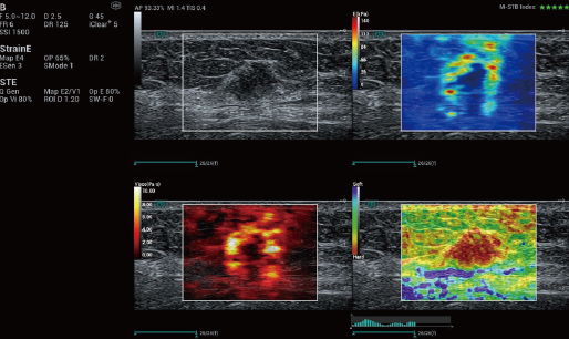 Breast Mass, M Reference