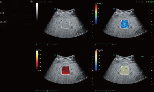 Fatty Liver, M Reference