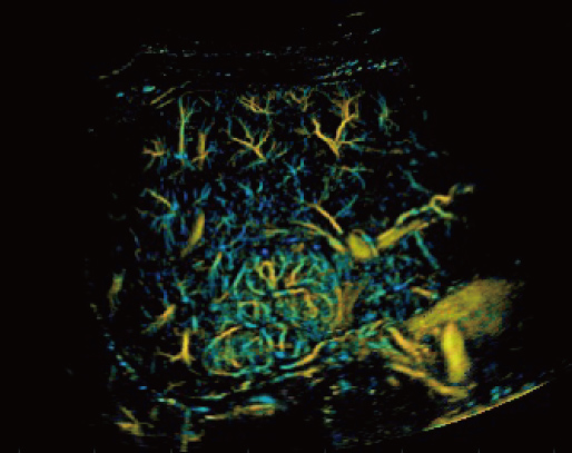 Focal Nodular Hyperplasia Blood Flow Density Map