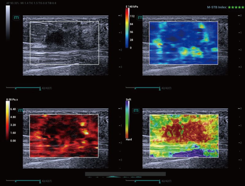 Breast Lesion STVi