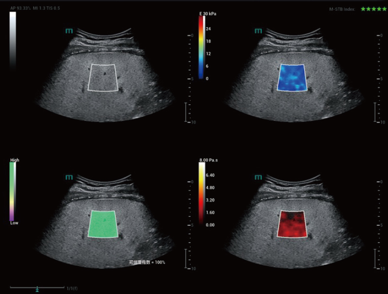 Fatty Liver STVi