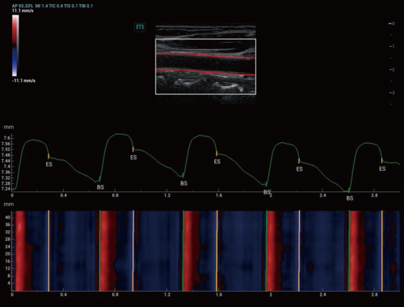 Carotid Artery Holo-PWV