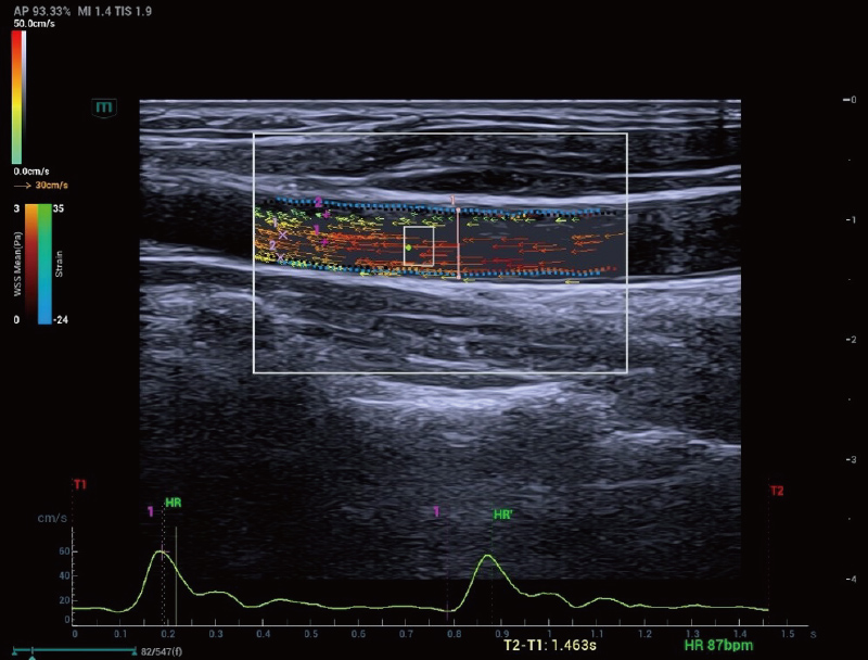 Carotid Artery V Flow