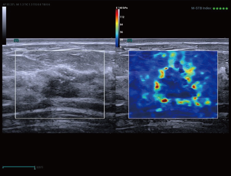 Breast Carcinoma, STE