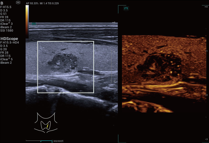 Resona A20 scan for Thyroid Nodule