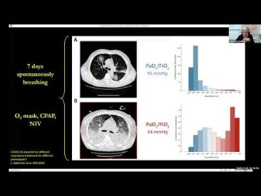 ARDS Management Webinar