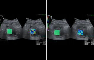 Ultrasound Journal 14 - Basic and advanced ultrasonographic techniques for evaluation of prostatic artery embolization: One stop shopping