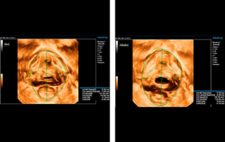 Ultrasound Journal 9 - Detection of Latent Urinary Incontinence in Women before SCGP