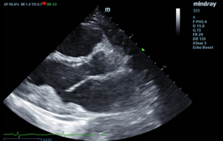 Ultrasound Journal 28 - Diagnosis of heart damage in hypereosinophilic syndrome using multiparametric transthoracic echocardiography