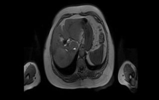 Ultrasound Journal 25 - Hepatocellular Carcinoma (HCC) in Non-Cirrhotic Liver Undergoing Right Hepatectomy Guided with Intraoperative Ultrasound